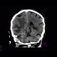Stroke, brain ischemia, fresh: CT - Computed tomography